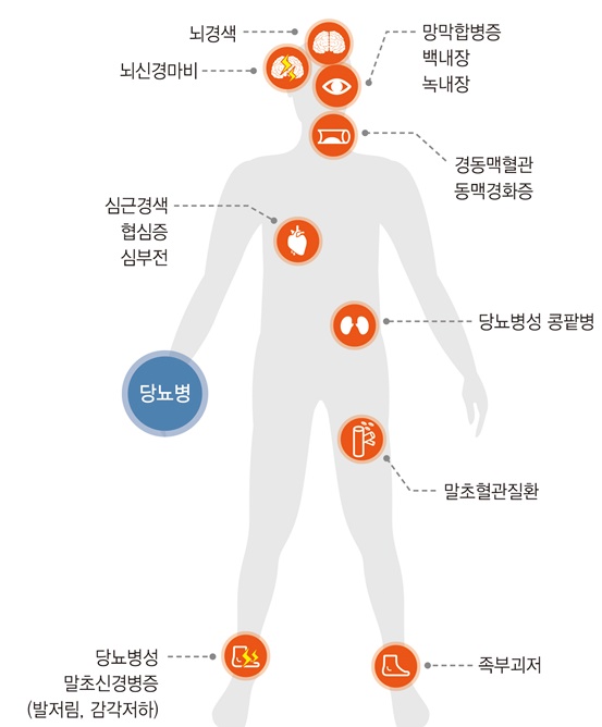 당뇨병 합병증의 종류(일러스트 강동경희대병원 제공).