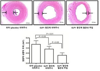 위약대비 GLP1 항진제 투여에 대한 경동맥 내중막 두께(동맥경화) 비교