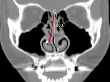 비중격만곡증 CT 사진. 코를 둘로 나누는 비중격이 정상인 C-S라인 보다 C-A라인(붉은색)으로 기울어져 있다.