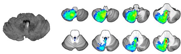 뇌 좌측 결절 부분에 뇌경색이 관찰되고 이로 인해 체위성 어지럼증/안진을 보인 환자의 MRI(좌측) 여러 환자들의 뇌병변 지도를 겹쳐 체위성 어지럼증/안진이 생기는 위치를 확인한 그림(우측).