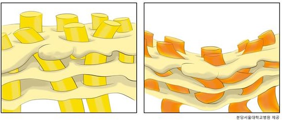 (좌) 사상판을 통해 시신경섬유(노란색 기둥) 다발이 지나가는 모양과 (우) 사상판이 압착되어 시신경섬유가 손상된 모습.