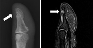 손가락 끝의 사구체 종양. 수지골의 함몰이 있으며 MRI 상 진단이 가능하다(사진 고려대 안암병원 제공).