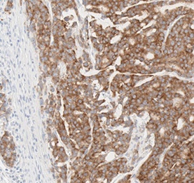 TRK 변이가 있는 대장암 조직의 단백질 발현 염색 이미지.