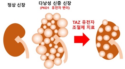 상염색체 우성 다낭성 신증의 TAZ 유전자 조절 치료(자료 대한신장학회 제공).