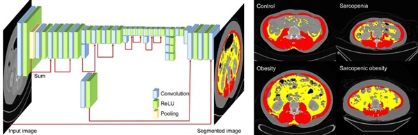 그림1)왼쪽) CT영상에서 인공지능을 이용해 몸의 체성분을 분류하는 과정, 오른쪽) 체성분에 따라 정상, 비만, 근감소증, 근감소성 비만의 대표적인 CT영상을 근육과 내장지방으로 구분한 이미지(빨간부분:근육, 노란부분:내장지방)